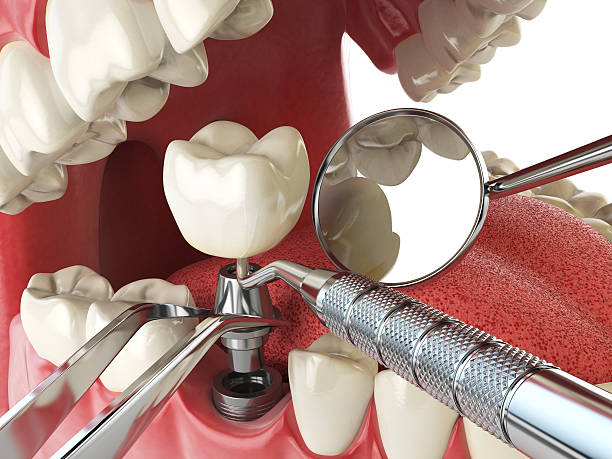 Best Emergency Root Canal Treatment in Lyman, SC